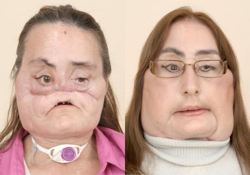 Ohio-woman-shows-off-US-face-transplant